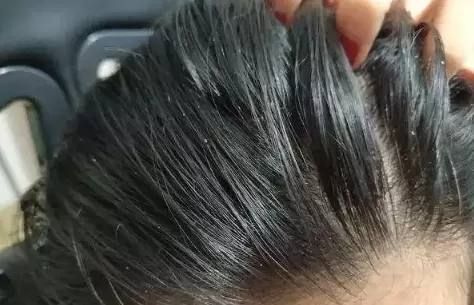睡觉时头皮痒越抓越痒像过敏一样