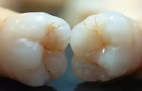 牙结石掉了牙龈空了牙龈会长吗3