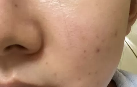 喝中药痤疮一个月了痤疮还是在长