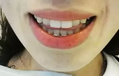 磨牙是什么原因引起的如何治疗