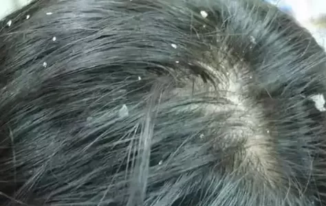 睡觉时头皮痒越抓越痒像过敏一样