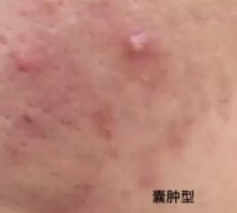 喝中药痤疮一个月了痤疮还是在长