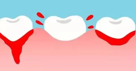 后槽牙崩了一小块要补吗