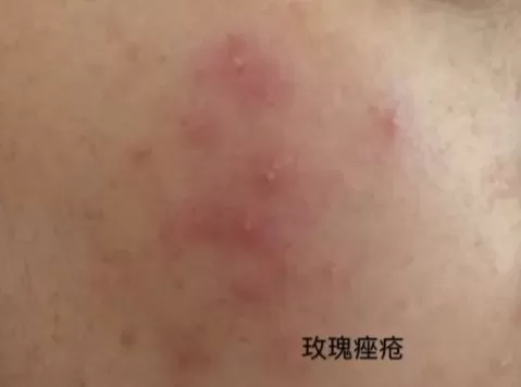 喝中药痤疮一个月了痤疮还是在长