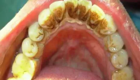 牙结石是什么样的图片3