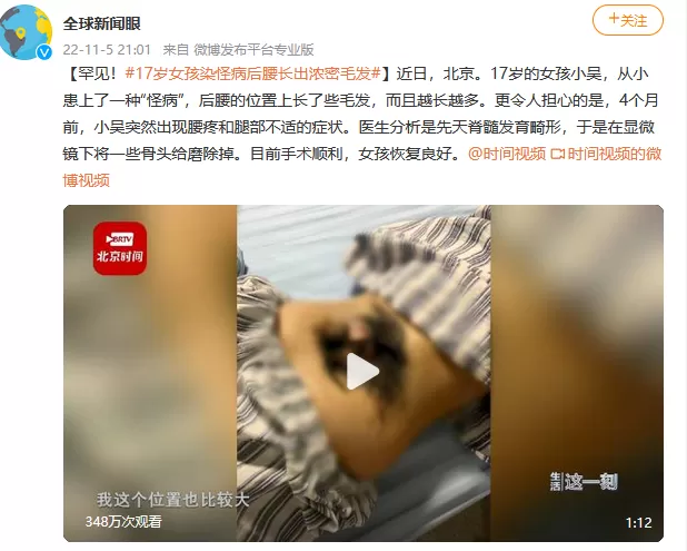 咋回事 女孩染怪病后腰长出浓密毛发