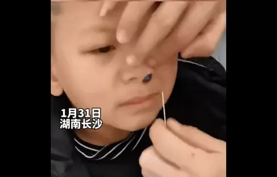 男孩不慎将弹珠塞鼻孔   爸爸拿挖耳勺各种掏最终却因一个动作而解救